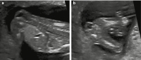 Abbildung 3a-b: Spina bifida  Prnataldiagnose