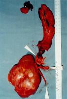 Abbildung 5: Nierenkarzinom - Tumorthrombose