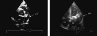 Figure 1: Echokardiographie - Linksatriale Thromben