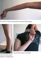 Abbildung 2: EDS-Hypermobilitt