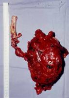 Abbildung 6: Nierenkarzinom - Tumorthrombose