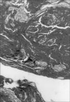 Figure 2: Thrombus - Histologie