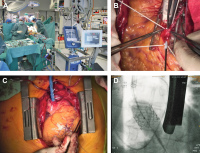 Abbildung 4a-d: ECMO
