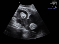 Abbildung 2: Uterus subseptus