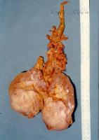 Abbildung 7: Nierenkarzinom - Tumorthrombose
