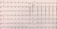 Abbildung 1: EKG