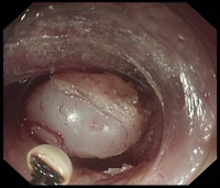 Abbildung 3: Subepithelialer Tumor