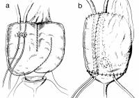 Abbildung 1: Mainz-Pouch-Substitution