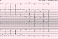 Abbildung 1: EKG