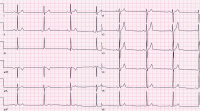 Abbildung 1: EKG
