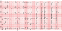Abbildung 1: EKG