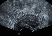 Abbildung 1: Subendometriale Fibrose