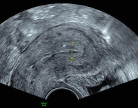 Abbildung 3: Subendometriale Fibrose