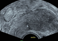 Abbildung 4: Subendometriale Fibrose