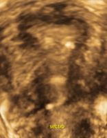 Abbildung 5: Subendometriale Fibrose