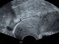 Abbildung 6: Subendometriale Fibrose