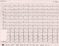 Abbildung 1: EKG - Aufnahme
