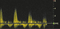 Abbildung 7: CW-Doppler-Signal