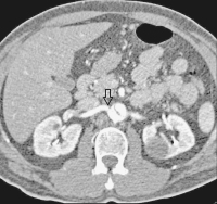 Abbildung 8: CT-Angiographie