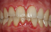 Abbildung 1: Schwangerschaftsgingivitis