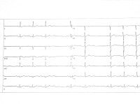 Abbildung 1: EKG