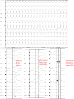 Abbildung 1: EKG