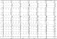 Abbildung 5: EKG