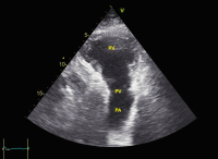 Abbildung 4: Pulmonalarterie