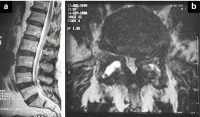 Abbildung 2a-b: Vertebrostenose
