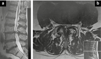Abbildung 3a-b: Vertebrostenose