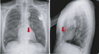 Abbildung 2: Pacemaker leads
