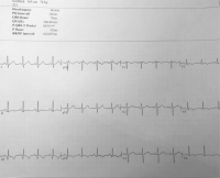 Abbildung 1: EKG