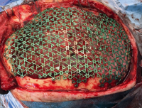 Abbildung 4: Titan-Mesh