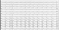 Abbildung 2: EKG
