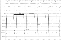 Abbildung 3: EKG