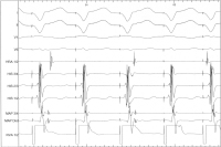 Abbildung 4: EKG