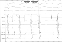 Abbildung 5: EKG 