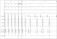 Abbildung 6: EKG