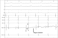 Abbildung 7: EKG