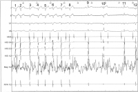 Abbildung 9: EKG