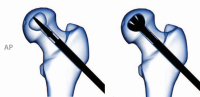 Abbildung 6: Dekompressionsystem