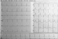Abbildung 1: EKG