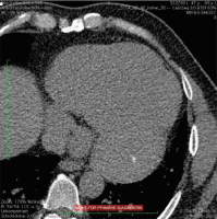 Abbildung 6: CT-Thorax