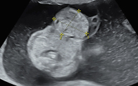 Abbildung 2: Omphalocele