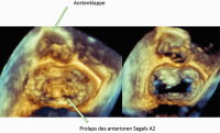 Abbildung 3: 3D-TEE surgical view