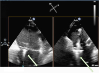 Abbildung 4a-b: MitraClip-Implantation