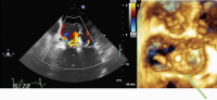 Abbildung 5a-b: MitraClip-Implantation