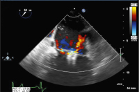 Abbildung 6: MitraClip-Implantation