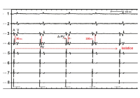 Abbildung 2: ECG and endograms