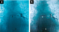 Abbildung 3a-b: Cryoablation of LUPV
